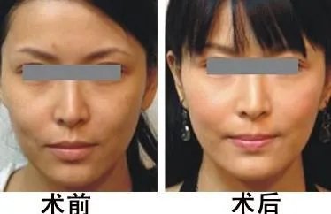 彩光嫩肤祛斑要多少钱