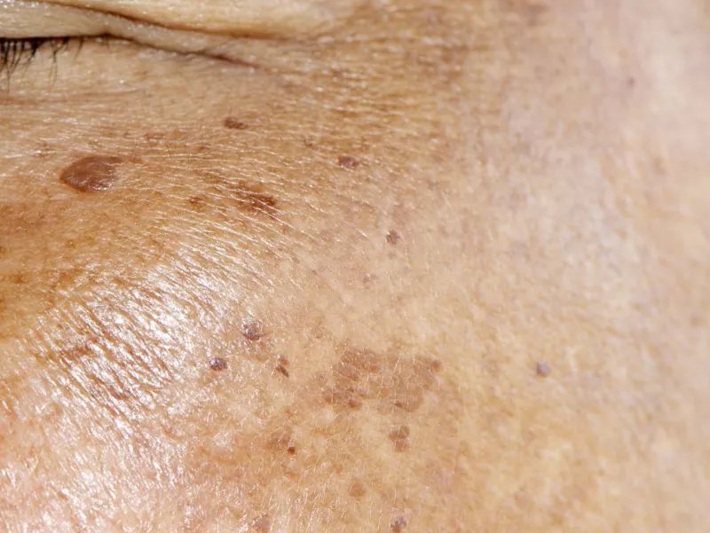 黄褐斑治疗价格