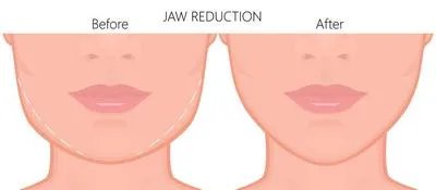 下颌角手术后遗症有哪些