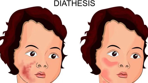 如何治疗脸部痤疮