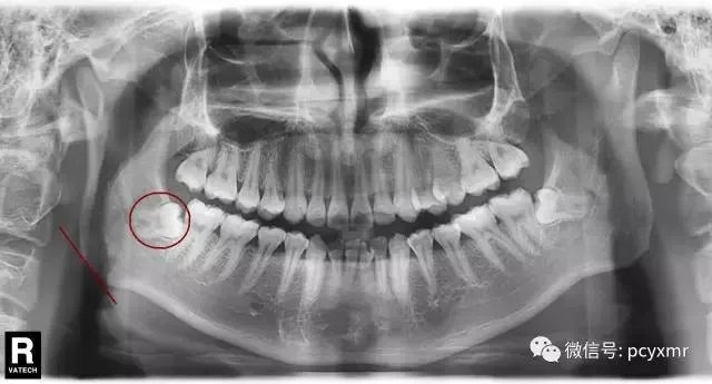 拔智齿真的可以瘦脸吗？有何依据？