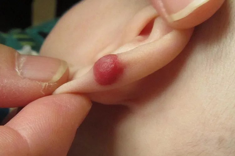 耳朵血管瘤图片