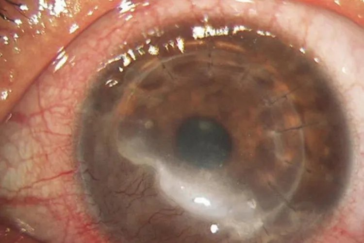 角膜炎初期症状图片