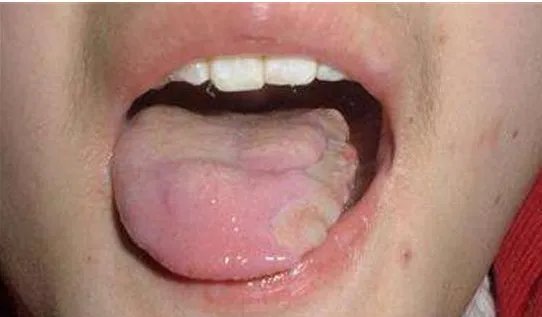 划伤舌头恶化舌癌是怎么回事？