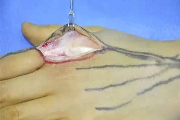 手指手术切口入路图