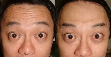 去抬头纹多少钱？