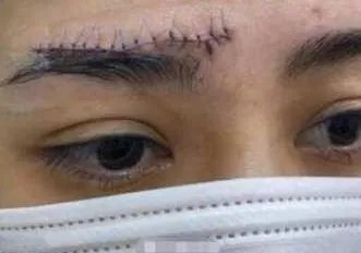 阿娇晒伤口照片,伤势恢复的怎样了?