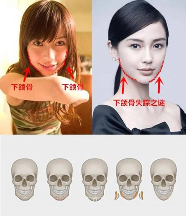 拔智齿真的可以瘦脸吗？有何依据？