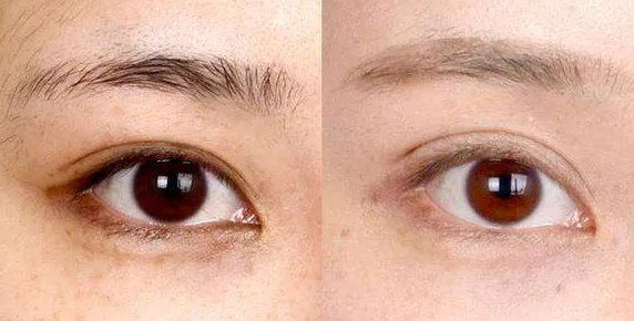 北京做双眼皮手术多少钱