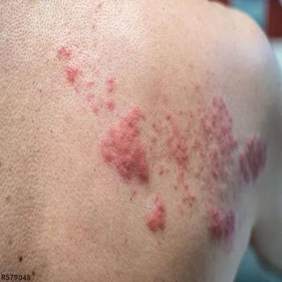 痤疮久治不愈怎么办