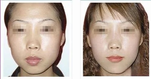 做自体脂肪丰下巴费用大概需要多少