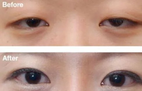 韩式翘睫双眼皮效果