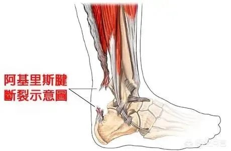 杜兰特G5复出再次受伤，勇士管理层真的不了解杜兰特伤情吗？