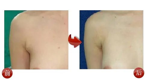 副乳整形效果前后对比