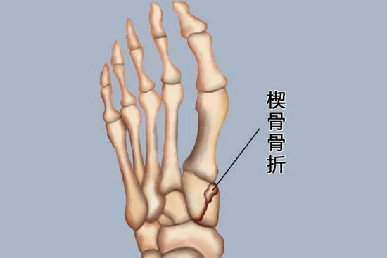 楔骨在哪个位置