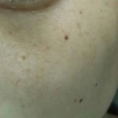 怎么样能不长老年斑?