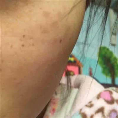 身上长黄褐斑怎么回事?
