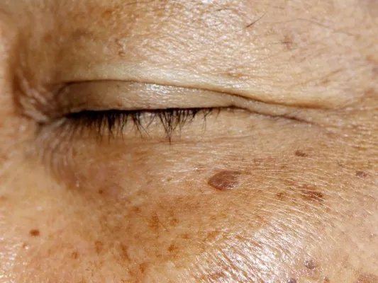 黄褐斑怎样祛除