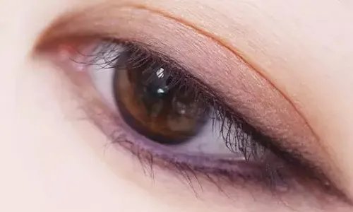 开内眼角手术后多久恢复