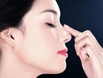 玻尿酸隆鼻瑞蓝2号能维持多久