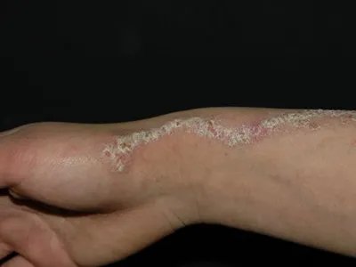线状疣状表皮痣手腕脱屑图片