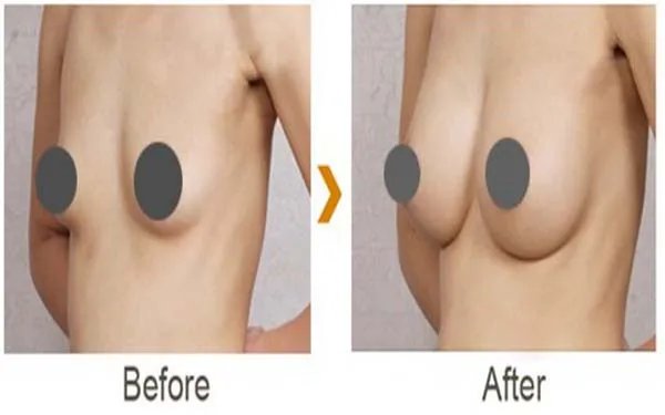 隆胸修复术的护理