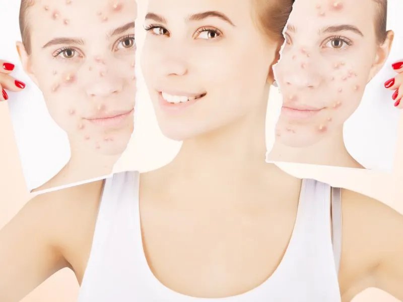 像素激光祛痘多少钱