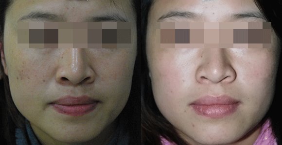 复合彩光嫩肤贵不贵 一般要多少钱