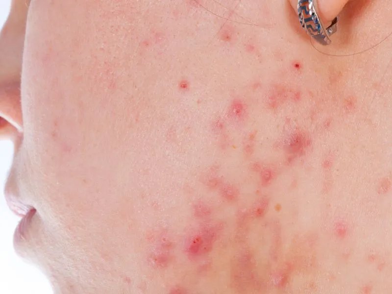 面部过敏的症状