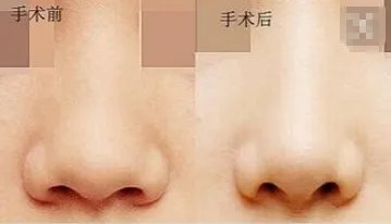 鼻翼缩小前后对比照片
