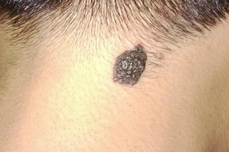 交界痣后颈症状图片