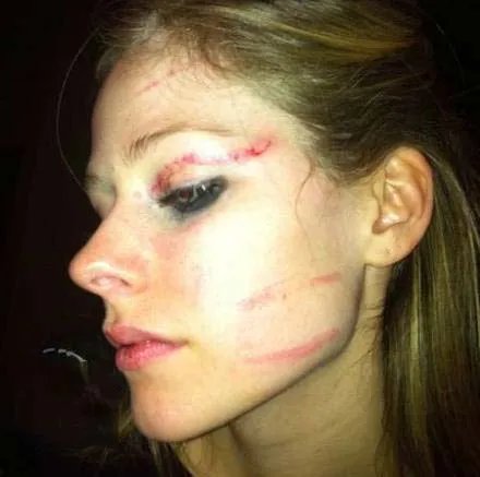 艾薇儿打架事件，毁容图片