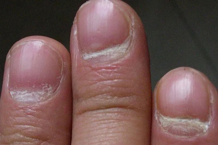 早期的灰指甲症状图片