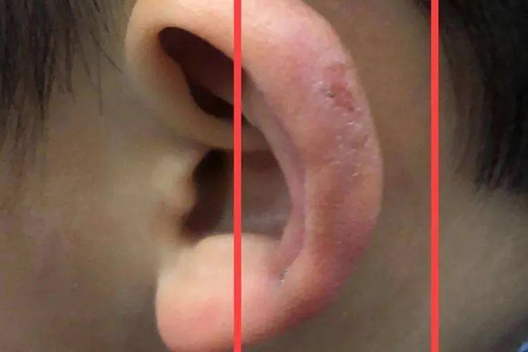 小孩外耳廓红肿痛图片