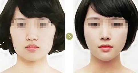 北京激光嫩肤价格