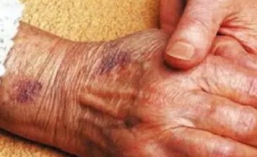 手上的老年斑怎样去掉