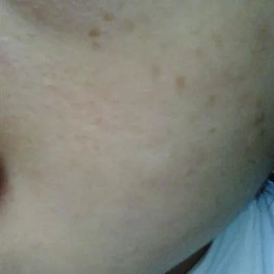 身上长黄褐斑怎么回事?