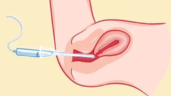 白色念珠菌病有什么症状