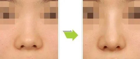 鼻子整小大概要多少钱