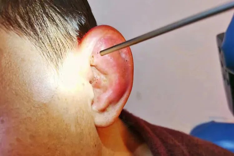 小孩外耳廓红肿痛图片