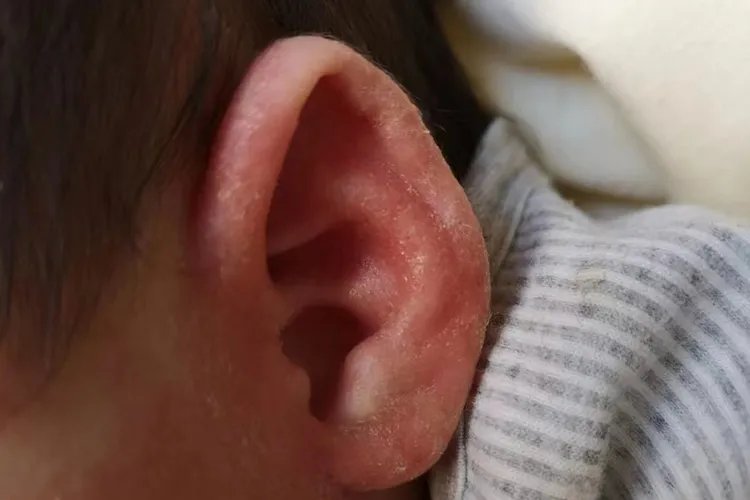 小孩外耳廓红肿痛图片