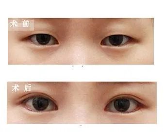 眼部整形大概多少钱