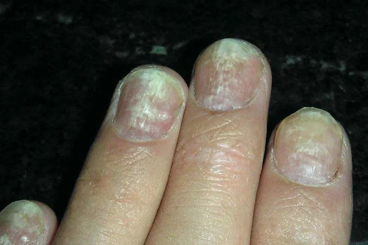 早期的灰指甲症状图片