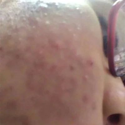 男士祛痘方法有哪些