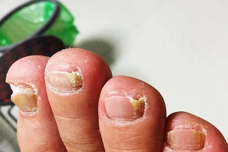 早期的灰指甲症状图片