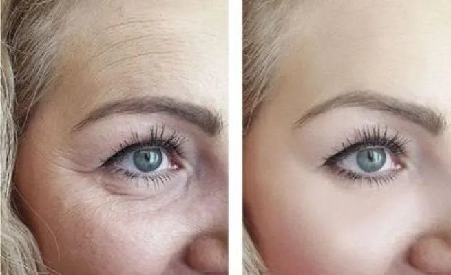 超声波去眼袋可靠吗 超声去眼袋手术的优势和注意事项揭秘