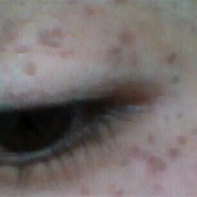 身上长黄褐斑怎么回事?