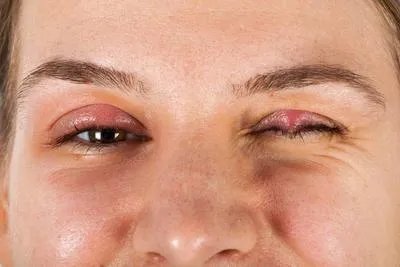 眼睛细菌感染怎么办 眼睛细菌感染的消除方法分享